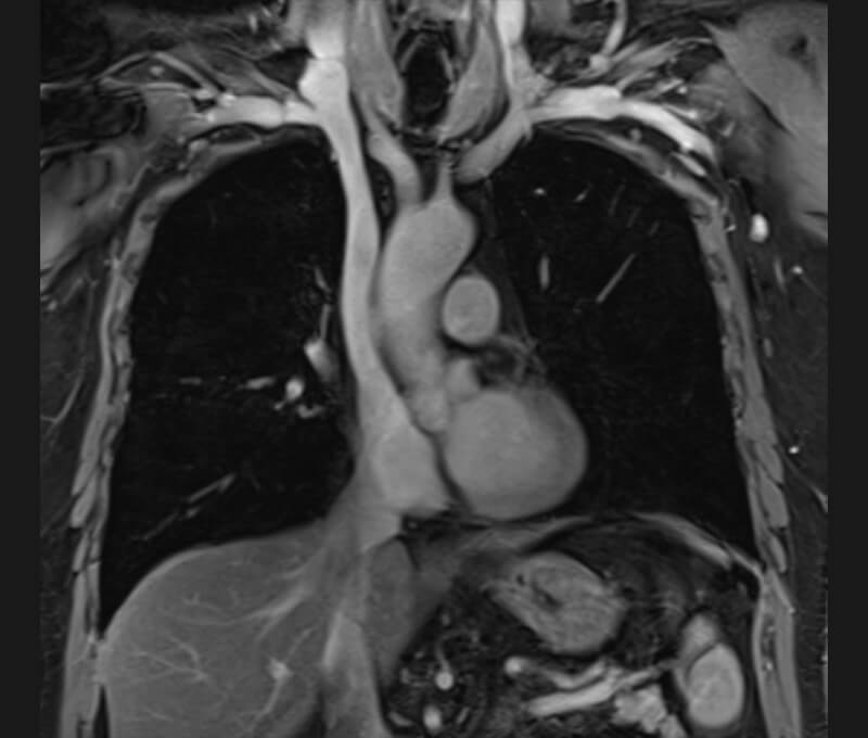 MRT-Thorax